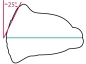 Preview: OrthoPreventAligner™ - BR = Bruxism; mixed dentition