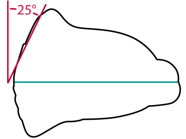 OrthoPreventAligner™ - BR = Bruxism; mixed dentition